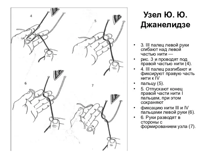 Узел Ю. Ю. Джанелидзе 3. III палец левой руки сгибают над левой
