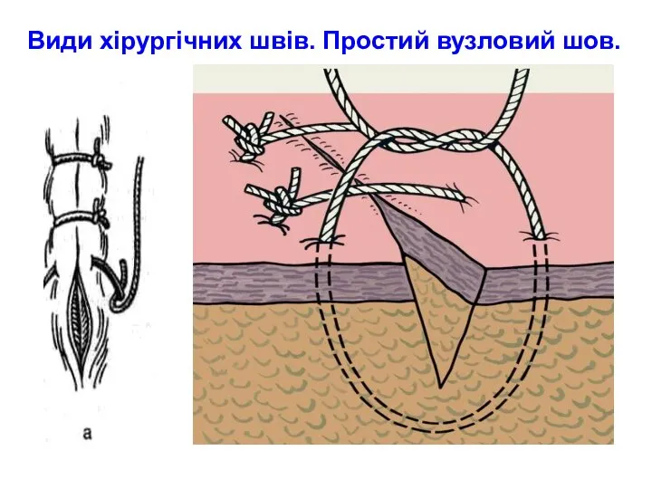 Види хірургічних швів. Простий вузловий шов.