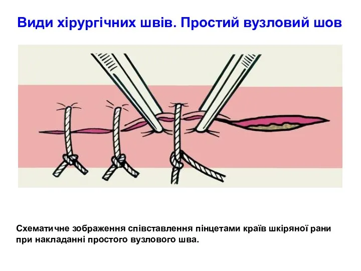 Види хірургічних швів. Простий вузловий шов Схематичне зображення співставлення пінцетами країв шкіряної