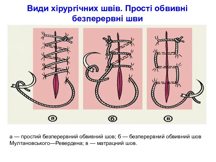 Види хірургічних швів. Прості обвивні безперервні шви а — простий безперервний обвивний