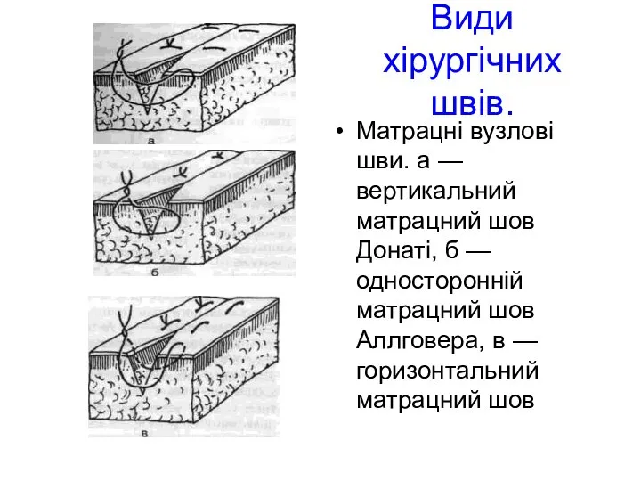 Види хірургічних швів. Матрацні вузлові шви. а — вертикальний матрацний шов Донаті,