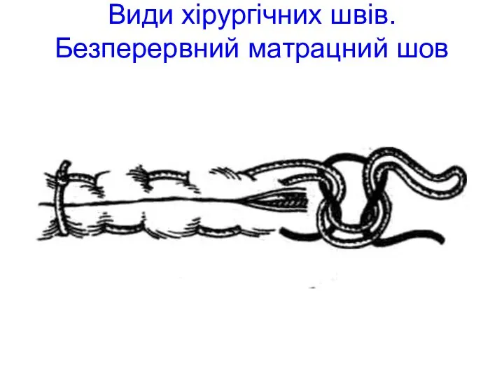 Види хірургічних швів. Безперервний матрацний шов