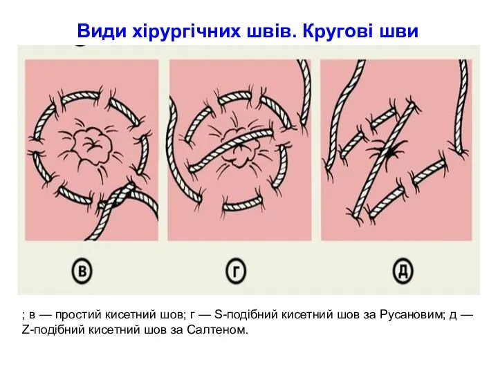 Види хірургічних швів. Кругові шви ; в — простий кисетний шов; г