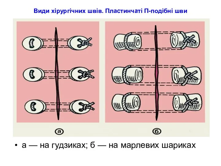 Види хірургічних швів. Пластинчаті П-подібні шви а — на гудзиках; б — на марлевих шариках