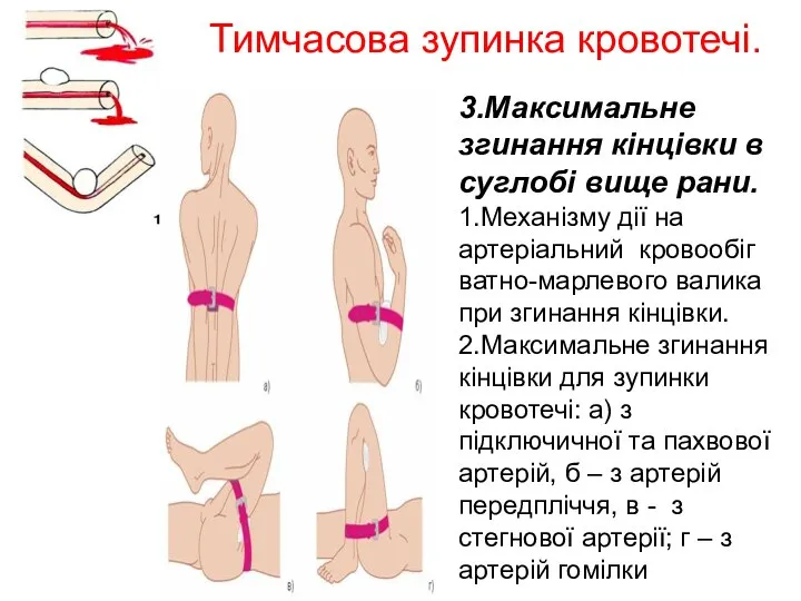 Тимчасова зупинка кровотечі. 3.Максимальне згинання кінцівки в суглобі вище рани. 1.Механізму дії