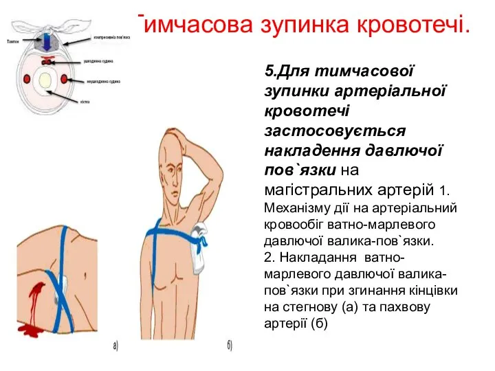 Тимчасова зупинка кровотечі. 5.Для тимчасової зупинки артеріальної кровотечі застосовується накладення давлючої пов`язки