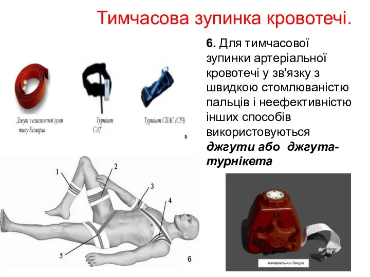 Тимчасова зупинка кровотечі. 6. Для тимчасової зупинки артеріальної кровотечі у зв'язку з