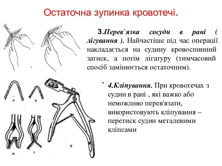 Остаточна зупинка кровотечі. - - 3.Перев`язка сосуди в рані ( лігування ).