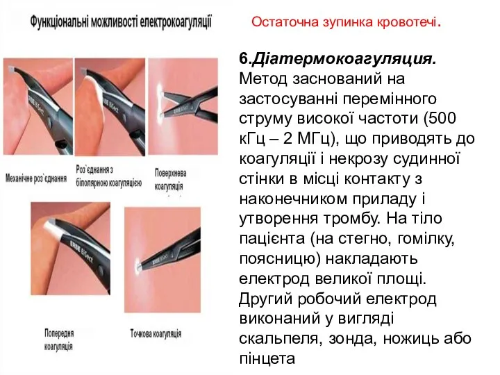 Остаточна зупинка кровотечі. , , 6.Діатермокоагуляция. Метод заснований на застосуванні перемінного струму