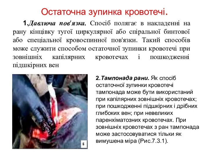 Остаточна зупинка кровотечі. 2.Тампонада рани. Як спосіб остаточної зупинки кровотечі тампонада може