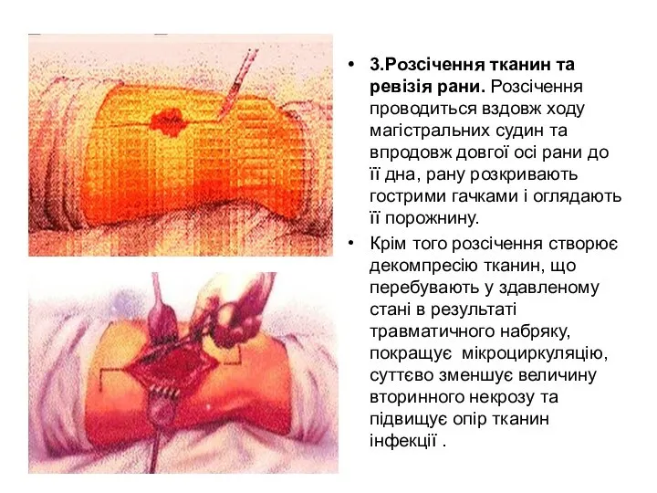 3.Розсічення тканин та ревізія рани. Розсічення проводиться вздовж ходу магістральних судин та