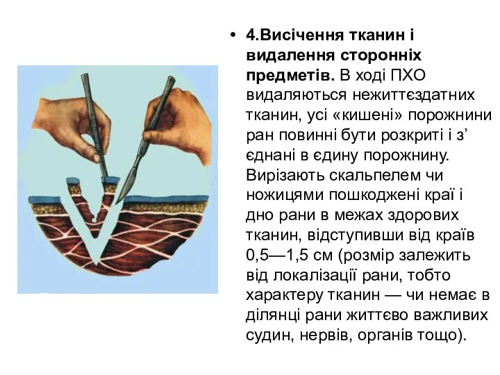 4.Висічення тканин і видалення сторонніх предметів. В ході ПХО видаляються нежиттєздатних тканин,