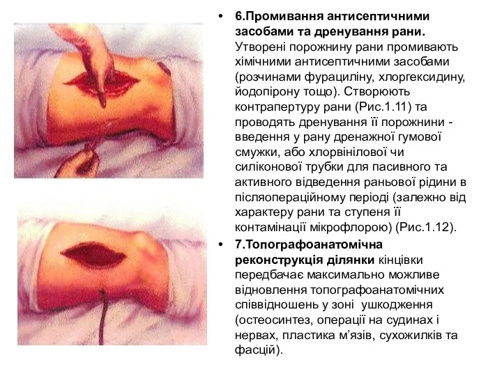 6.Промивання антисептичними засобами та дренування рани. Утворені порожнину рани промивають хімічними антисептичними