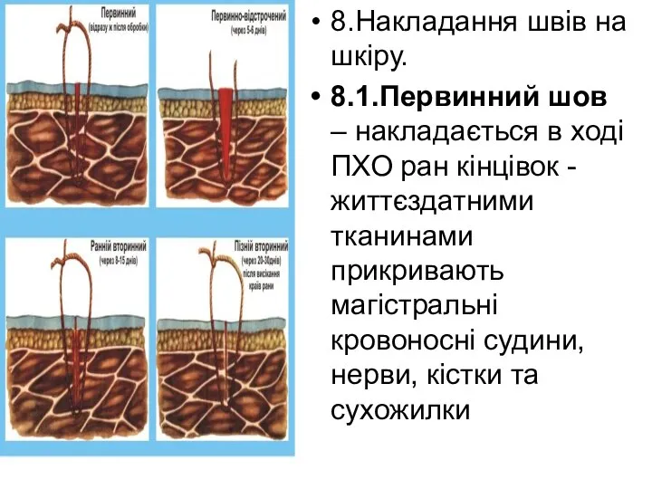 8.Накладання швів на шкіру. 8.1.Первинний шов – накладається в ході ПХО ран