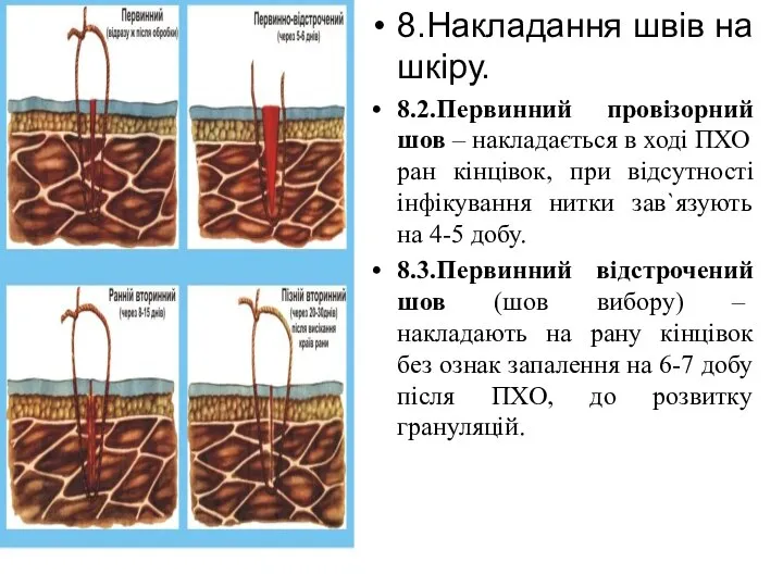 8.Накладання швів на шкіру. 8.2.Первинний провізорний шов – накладається в ході ПХО