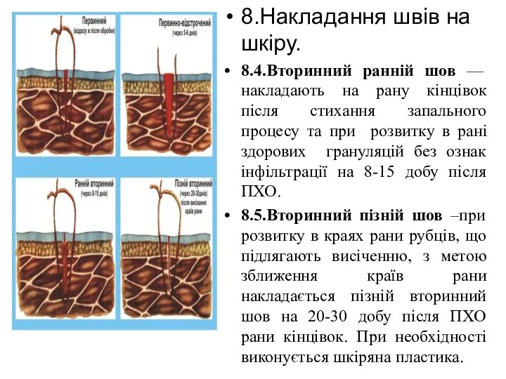 8.Накладання швів на шкіру. 8.4.Вторинний ранній шов — накладають на рану кінцівок