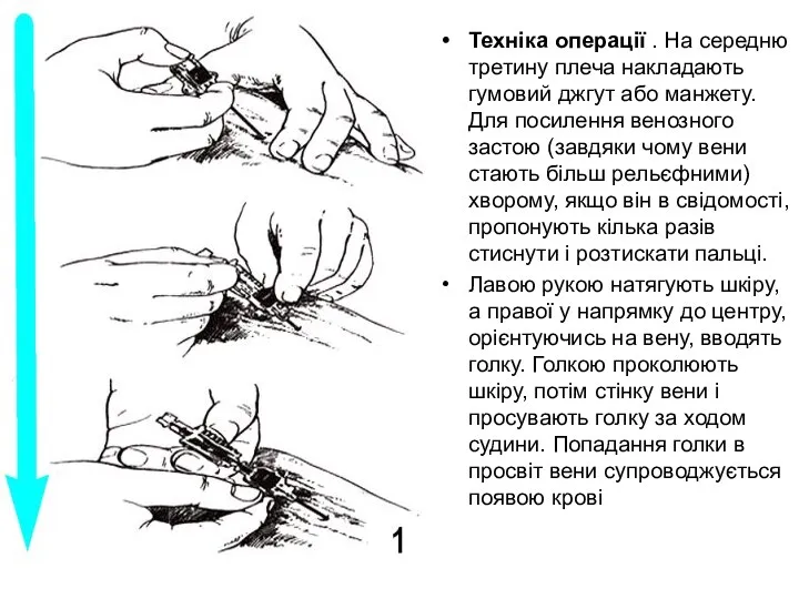 Техніка операції . На середню третину плеча накладають гумовий джгут або манжету.