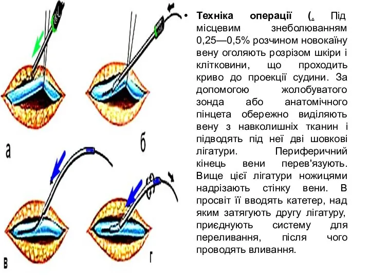Техніка операції (. Під місцевим знеболюванням 0,25—0,5% розчином новокаїну вену оголяють розрізом