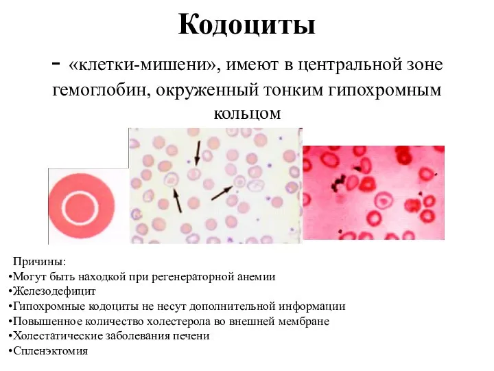 Кодоциты - «клетки-мишени», имеют в центральной зоне гемоглобин, окруженный тонким гипохромным кольцом