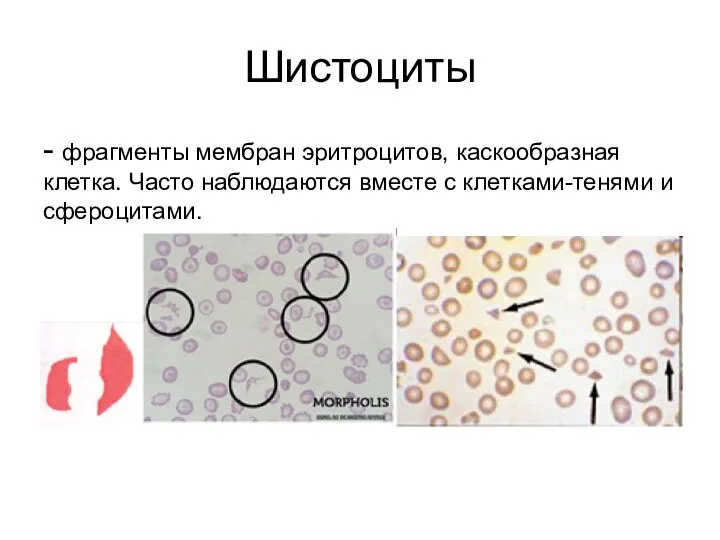 Шистоциты - фрагменты мембран эритроцитов, каскообразная клетка. Часто наблюдаются вместе с клетками-тенями и сфероцитами.