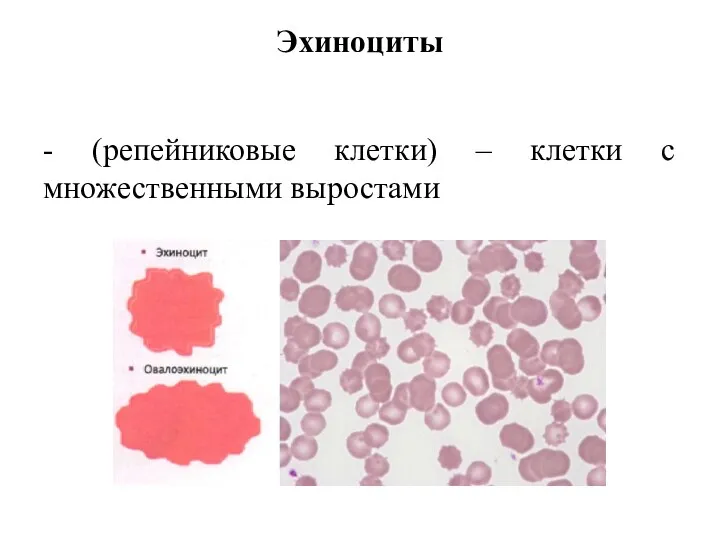 Эхиноциты - (репейниковые клетки) – клетки с множественными выростами