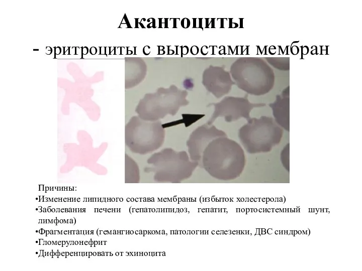 Акантоциты - эритроциты с выростами мембран Причины: Изменение липидного состава мембраны (избыток