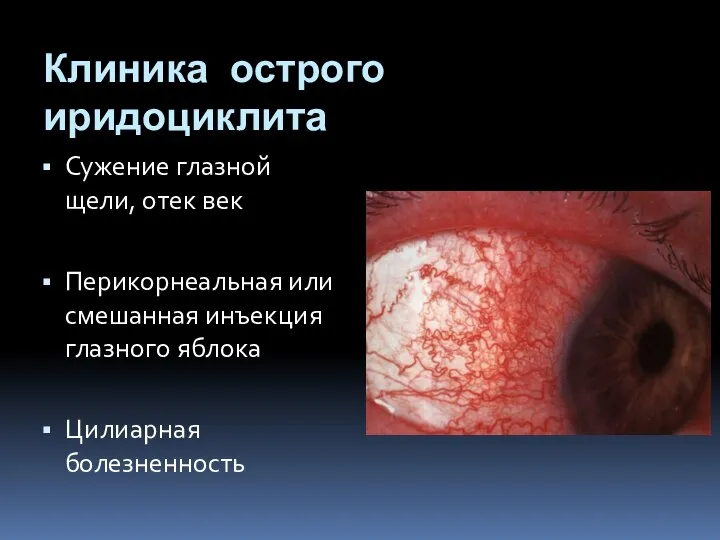 Клиника острого иридоциклита Сужение глазной щели, отек век Перикорнеальная или смешанная инъекция глазного яблока Цилиарная болезненность