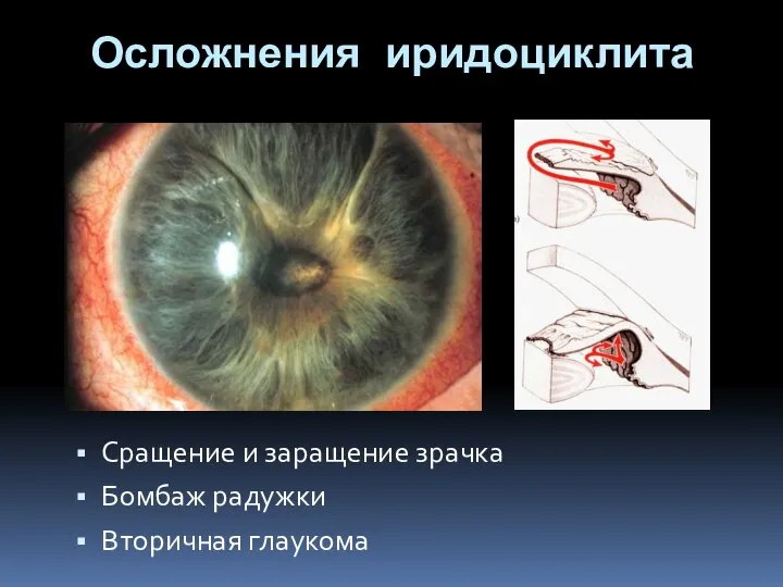 Осложнения иридоциклита Сращение и заращение зрачка Бомбаж радужки Вторичная глаукома