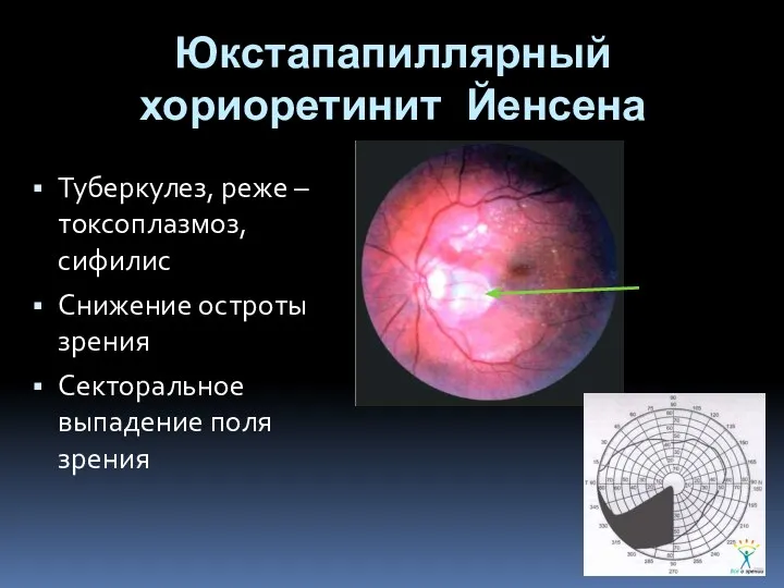 Юкстапапиллярный хориоретинит Йенсена Туберкулез, реже – токсоплазмоз, сифилис Снижение остроты зрения Секторальное выпадение поля зрения