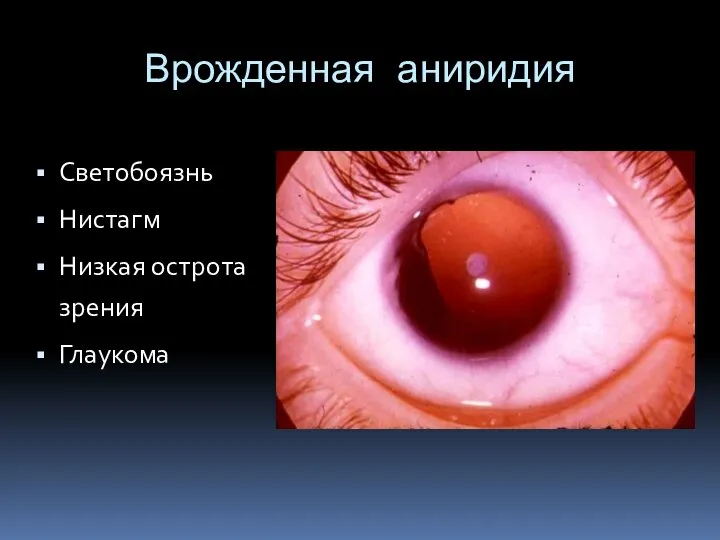 Врожденная аниридия Светобоязнь Нистагм Низкая острота зрения Глаукома