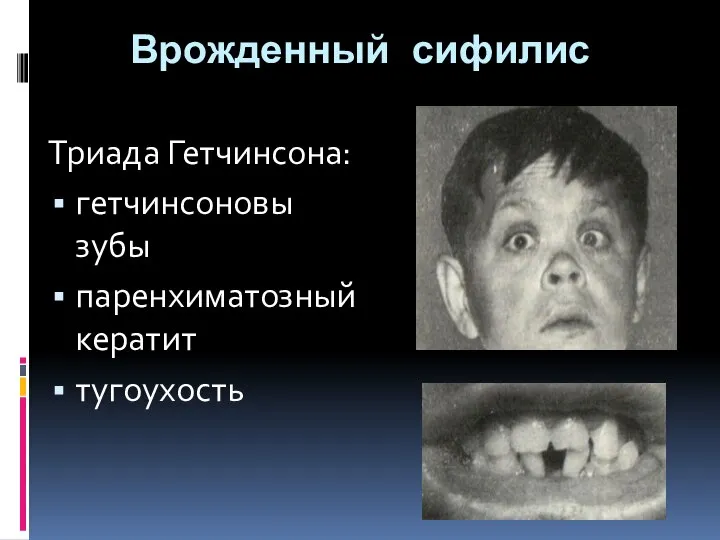 Врожденный сифилис Триада Гетчинсона: гетчинсоновы зубы паренхиматозный кератит тугоухость