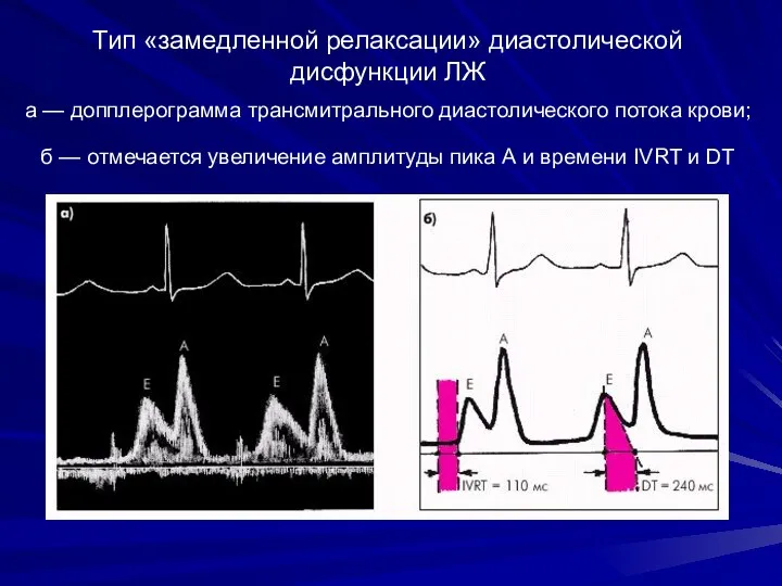 Тип «замедленной релаксации» диастолической дисфункции ЛЖ а — допплерограмма трансмитрального диастолического потока