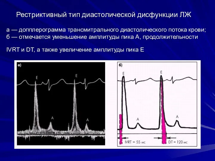 Рестриктивный тип диастолической дисфункции ЛЖ а — допплерограмма трансмитрального диастолического потока крови;