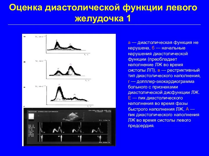 Оценка диастолической функции левого желудочка 1 а — диастолическая функция не нарушена,