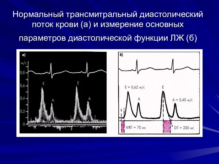 Нормальный трансмитральный диастолический поток крови (а) и измерение основных параметров диастолической функции ЛЖ (б)