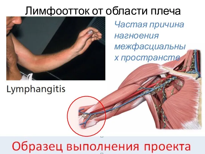 Лимфоотток от области плеча Частая причина нагноения межфасциальных пространств