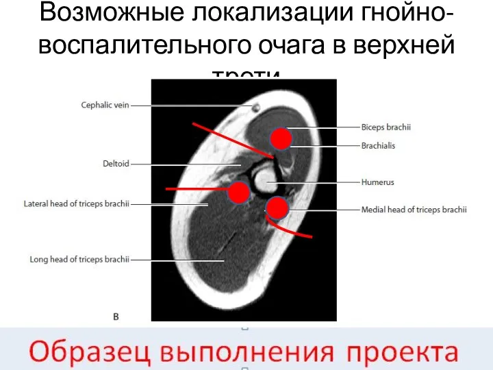 Возможные локализации гнойно-воспалительного очага в верхней трети