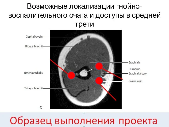 Возможные локализации гнойно-воспалительного очага и доступы в средней трети