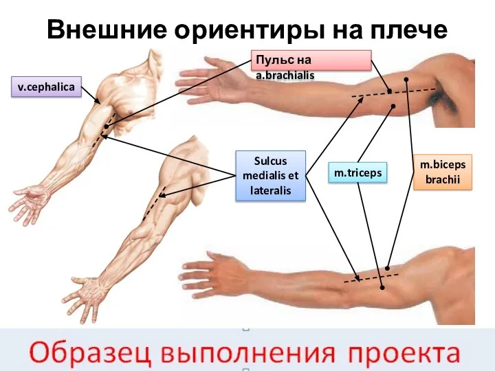 Внешние ориентиры на плече Sulcus medialis et lateralis v.cephalica m.triceps m.biceps brachii Пульс на a.brachialis