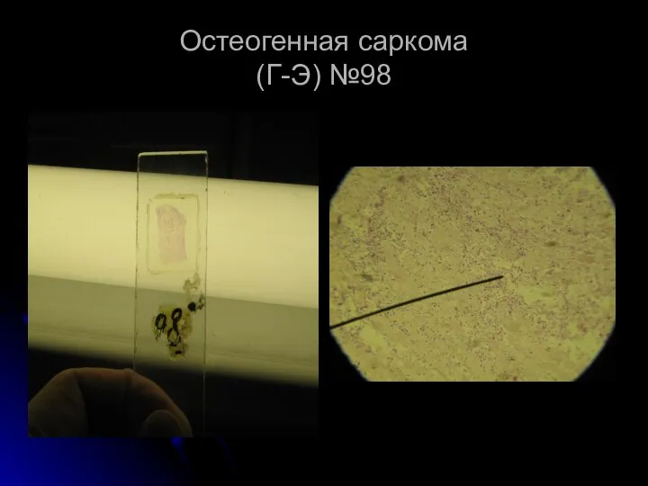 Остеогенная саркома (Г-Э) №98