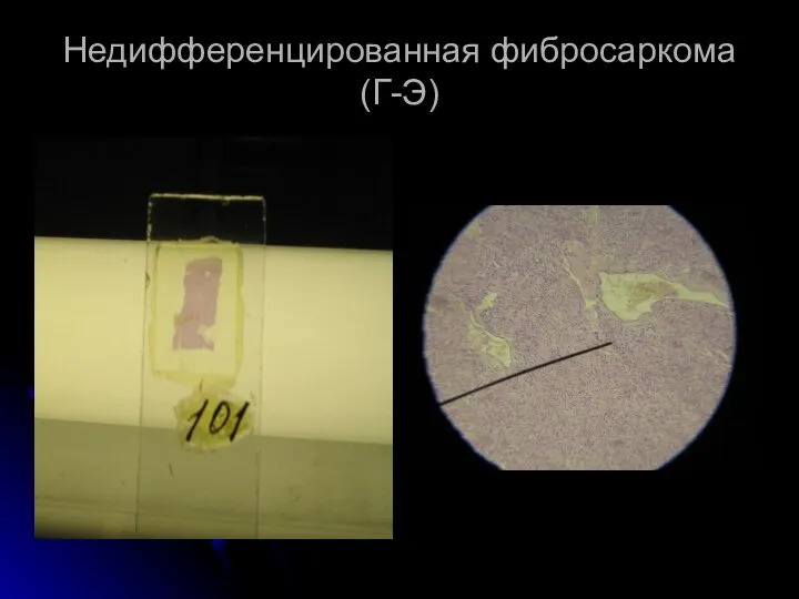 Недифференцированная фибросаркома (Г-Э)