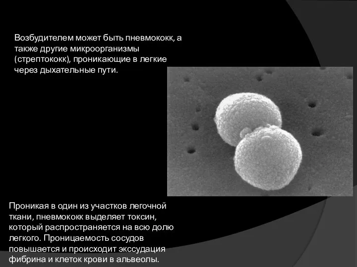 Возбудителем может быть пневмококк, а также другие микроорганизмы (стрептококк), проникающие в легкие