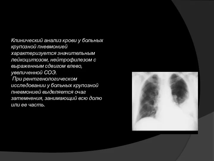 Клинический анализ крови у больных крупозной пневмонией характеризуется значительным лейкоцитозом, нейтрофилезом с