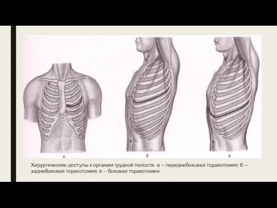 Хирургические доступы к органам грудной полости. а – переднебоковая торакотомия; б –