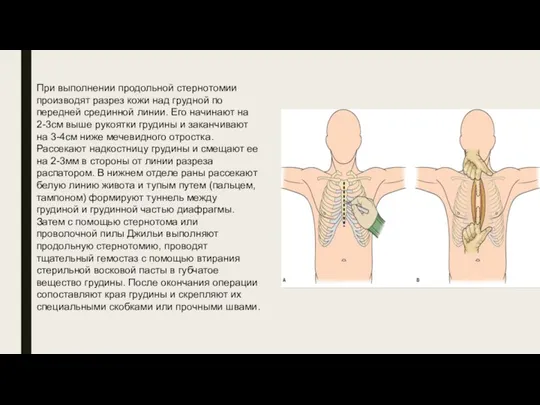 При выполнении продольной стернотомии производят разрез кожи над грудной по передней срединной