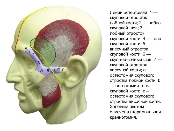 Линии остеотомий. 1 — скуловой отросток лобной кости; 2 — лобно-скуловой шов;