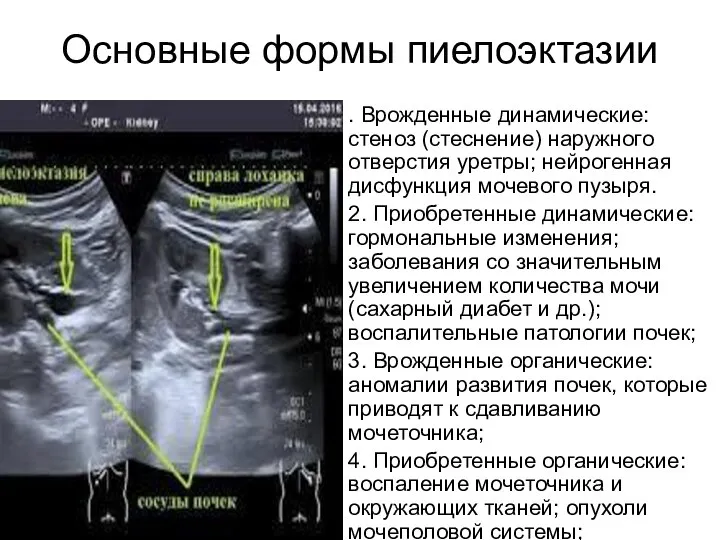 Основные формы пиелоэктазии . Врожденные динамические: стеноз (стеснение) наружного отверстия уретры; нейрогенная