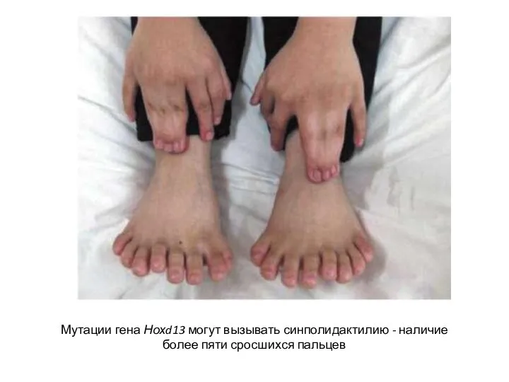 Мутации гена Нохd13 могут вызывать синполидактилию - наличие более пяти сросшихся пальцев