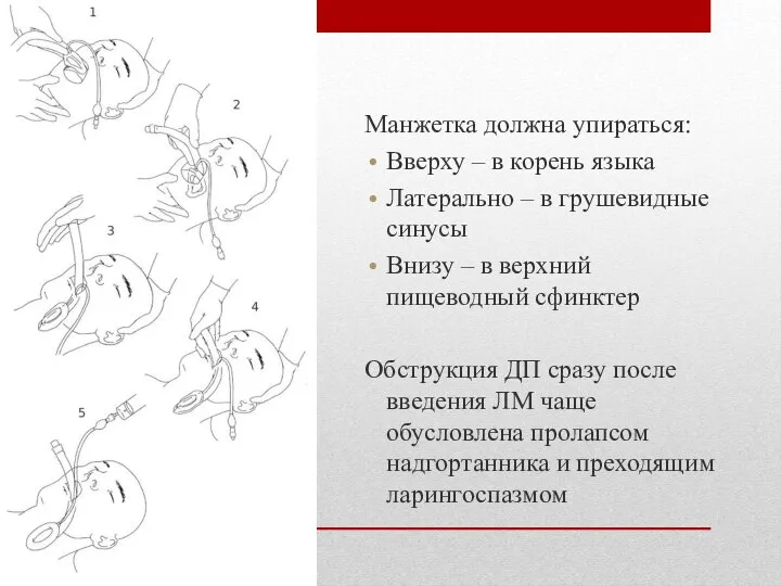 Манжетка должна упираться: Вверху – в корень языка Латерально – в грушевидные