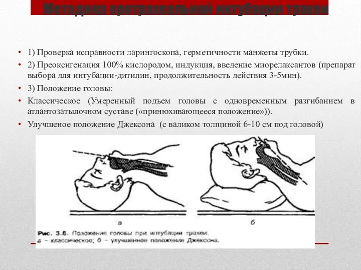 Методика оротрахеальной интубации трахеи 1) Проверка исправности ларингоскопа, герметичности манжеты трубки. 2)